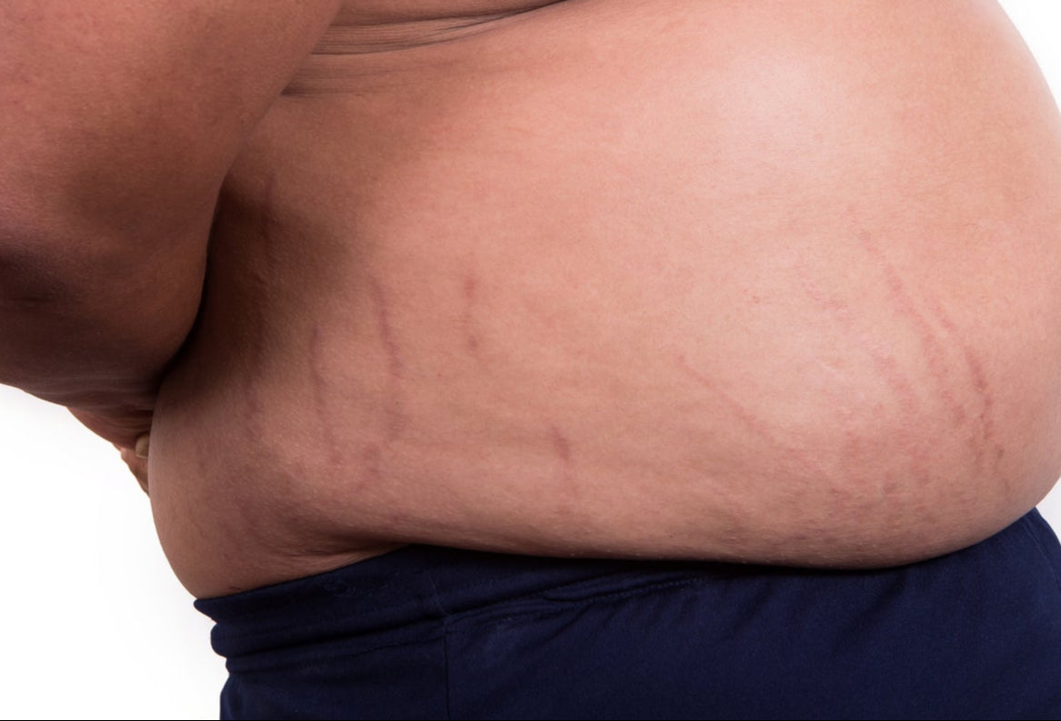 V2 Revolution Stretch Mark & Cellulite Solution
