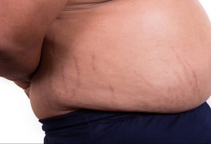 V2 Revolution Stretch Mark & Cellulite Solution